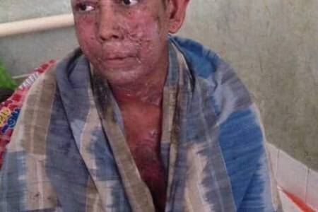 Leprosy patient-privileged touch